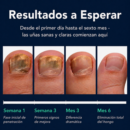 NailVita™ Lápiz Antifúngico [Uñas Saludables y Hermosas]